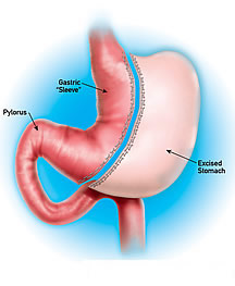 sleeve_gastrectomy_pic