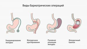 виды бариатрических операций